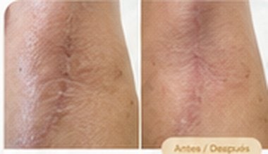 Antes y después: mejora visible de cicatrices