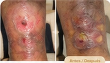 Antes y después: úlceras venosas con avances significativos